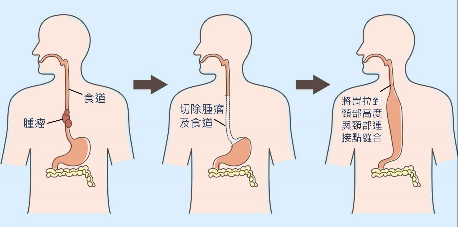 食道癌晚期可以动手术 能治好吗 - 知乎