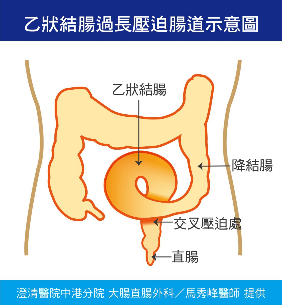 乙状结肠就位于降结肠和直肠之间,是大肠的降结肠和直肠之间的肠道