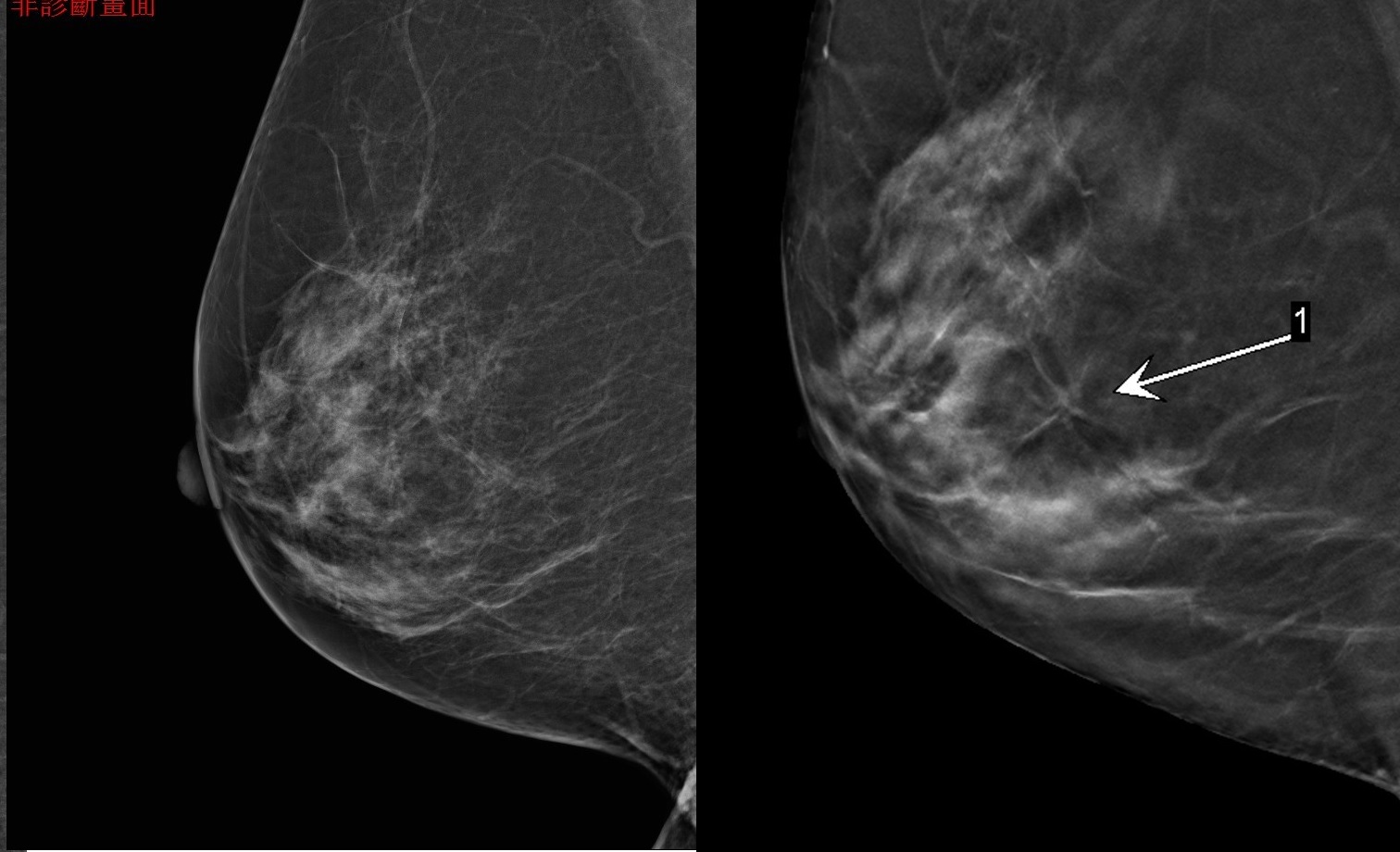 3D乳房斷層攝影 提早發現病灶