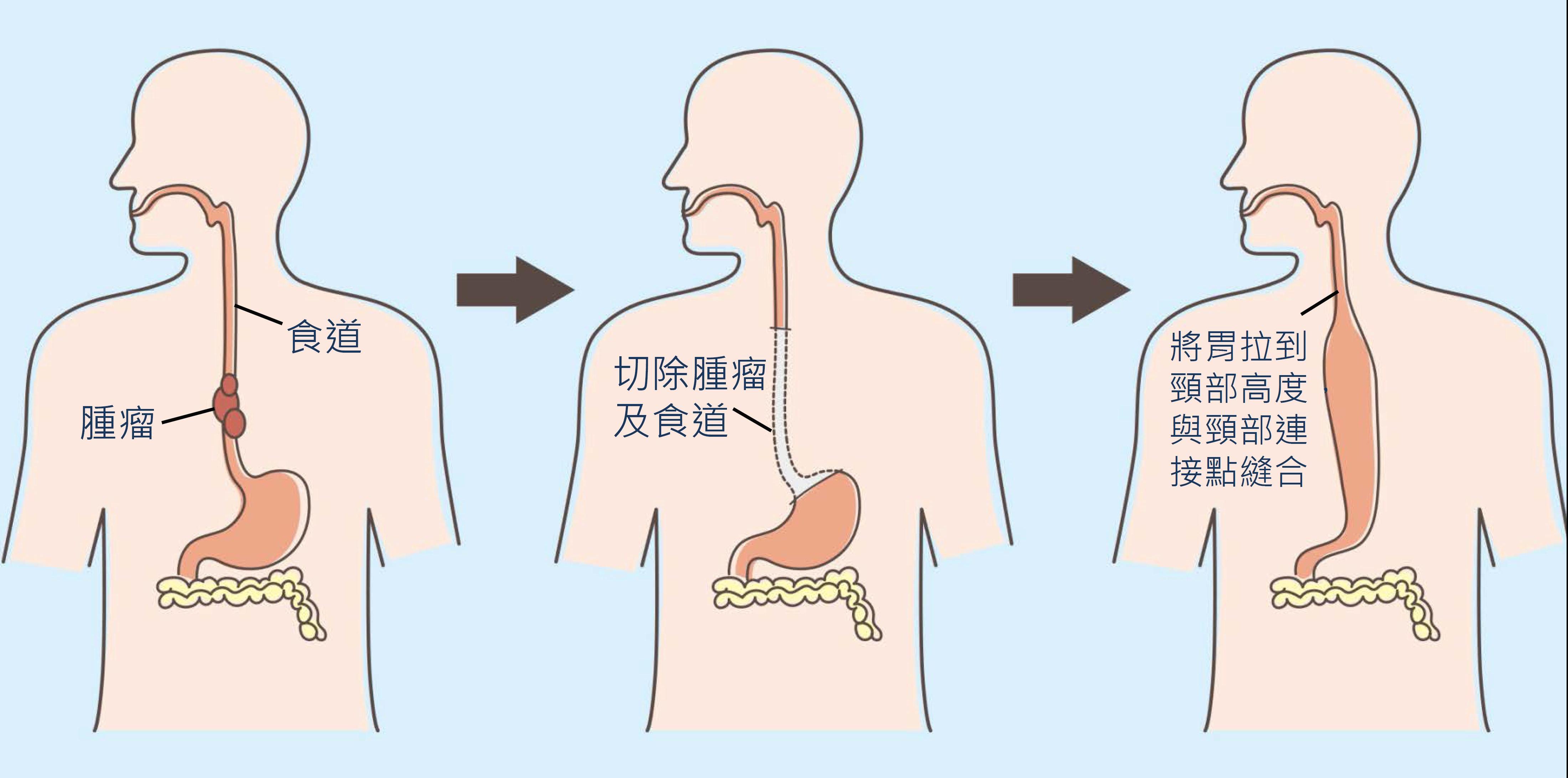 食道图片高清