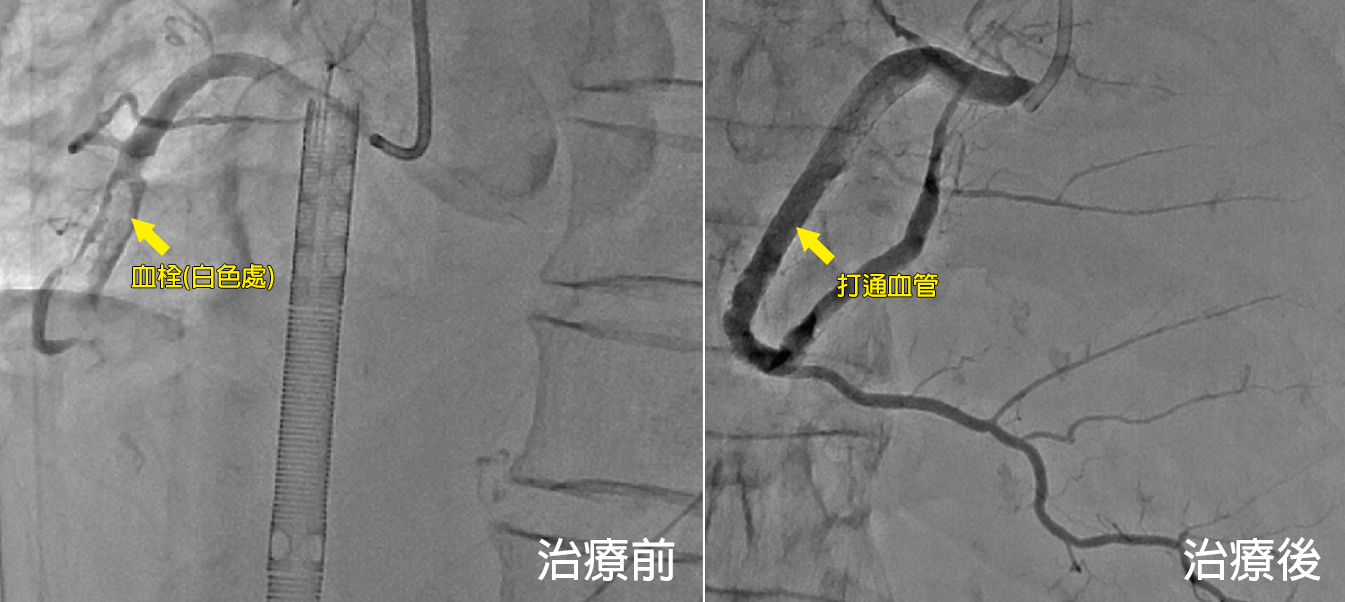 婦人突聞自己心跳聲    竟是冠狀動脈血栓完全阻塞