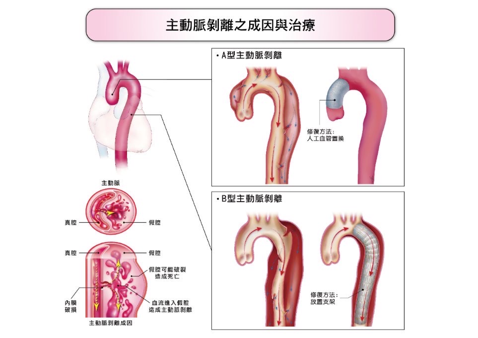 長庚研究：孕婦高血壓容易引起主動脈病變