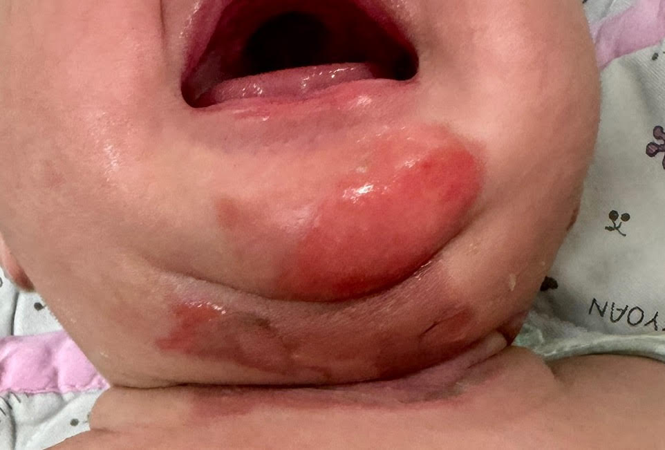 嬰兒鼻塞竟用蒸氣舒緩   滿月嬰半身燙傷起水泡