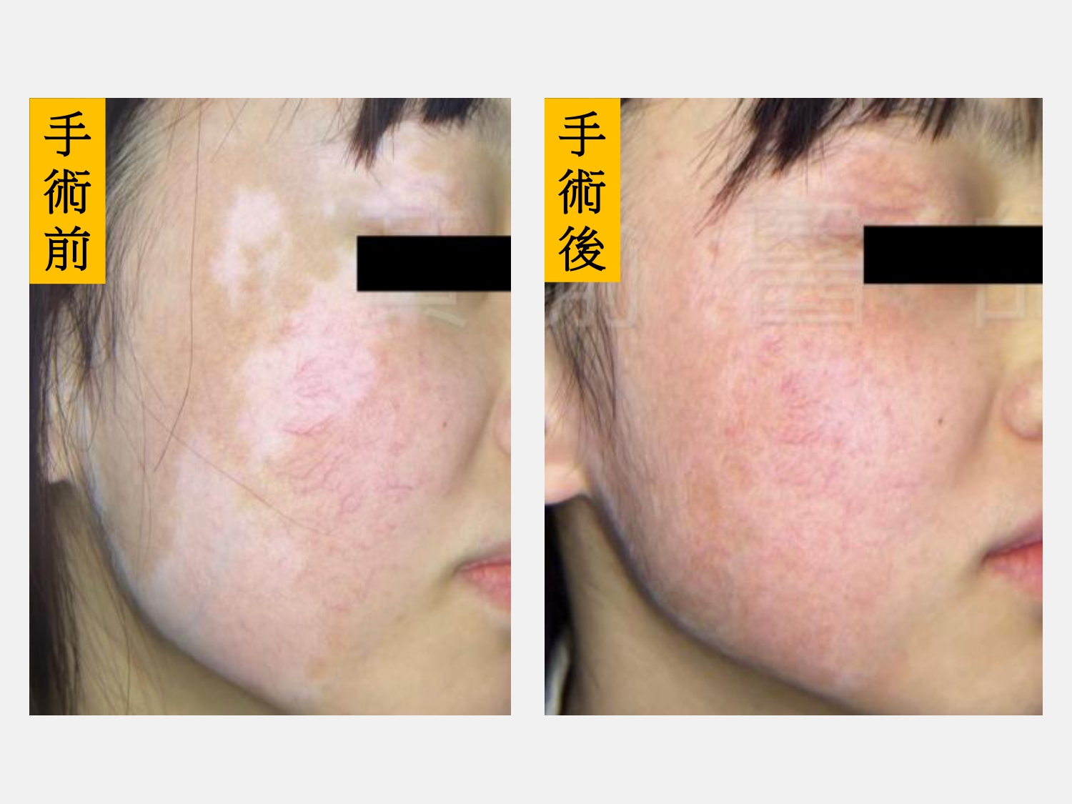 圖：女童手術前後對照，順利改善膚色，且無疤痕形成／大里仁愛醫院提供