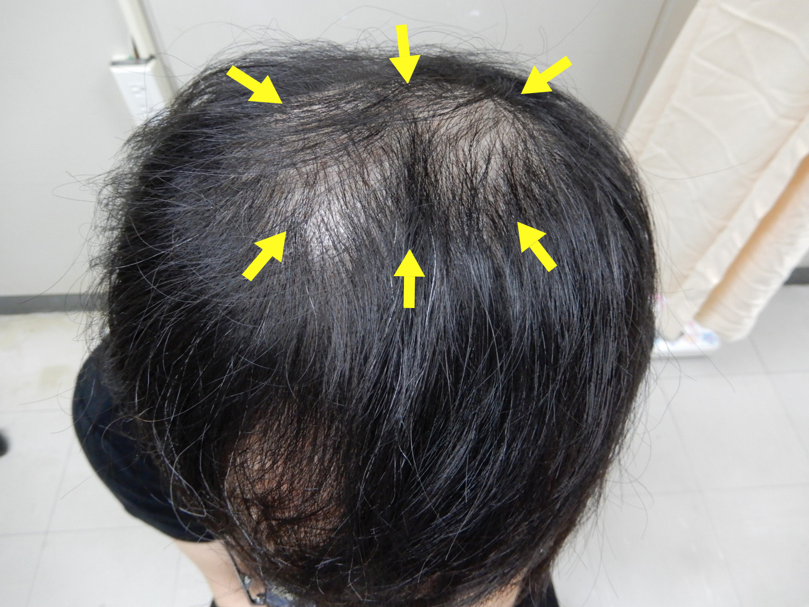 圖：容易忽略的梅毒造成的掉髮，箭頭指範圍／澄清醫院提供