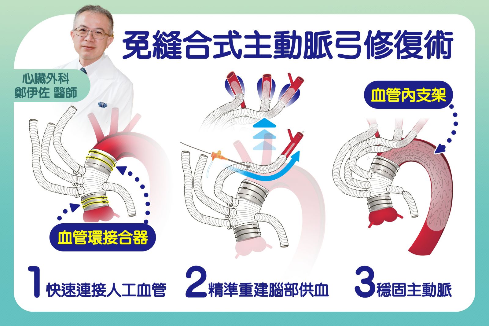 圖：「免縫合式主動脈弓混合型手術」三步驟，讓急性主動脈剝離手術更快、更安全／台中慈濟醫院提供