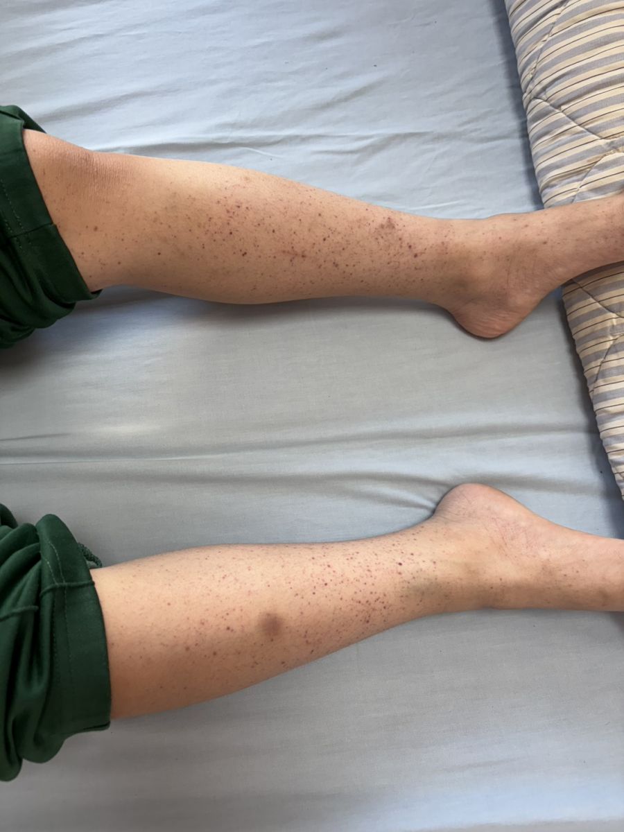 圖：病童身體出現小血點／彰化醫院提供