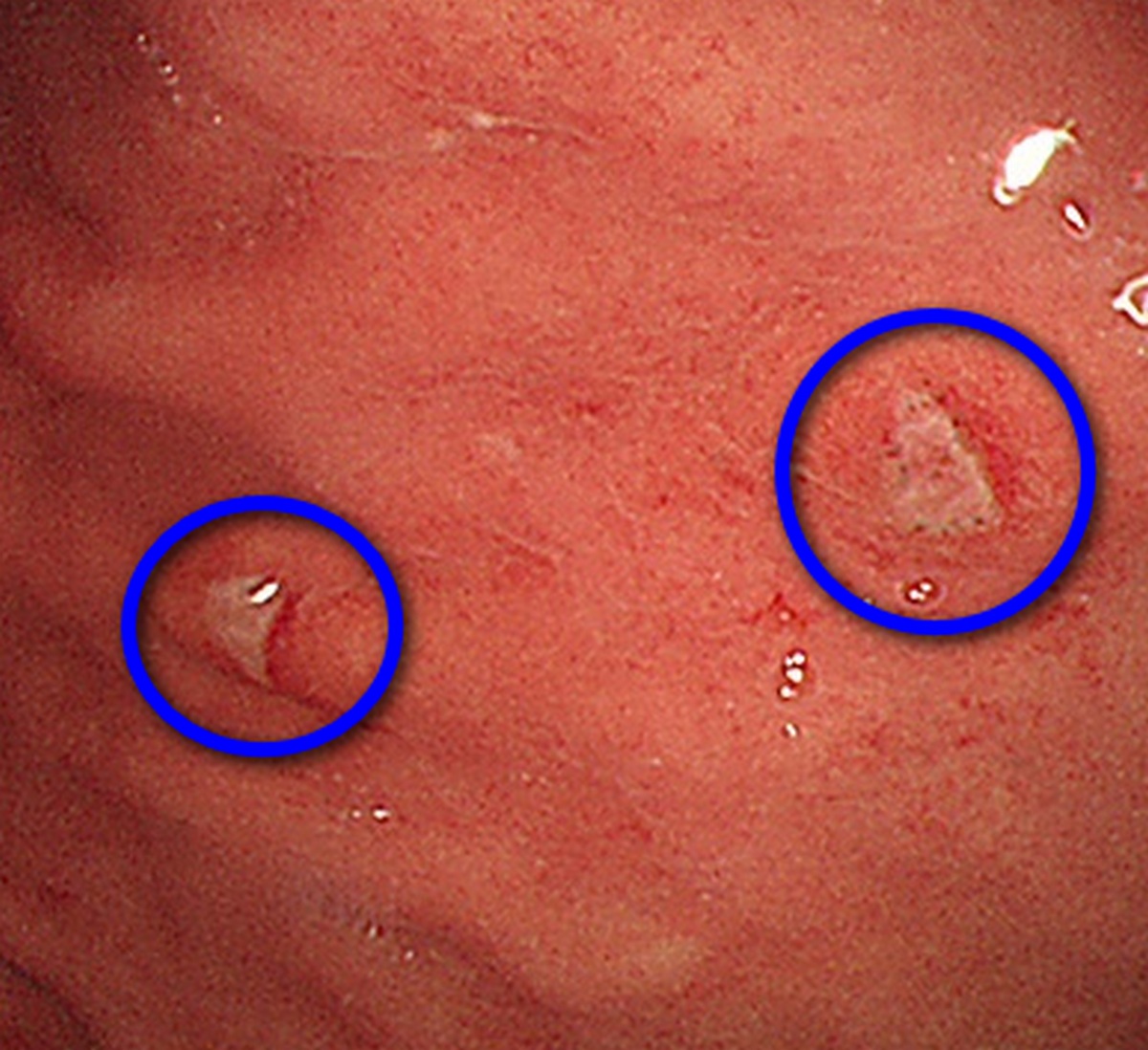 结肠癌粪便图片 潜血图片