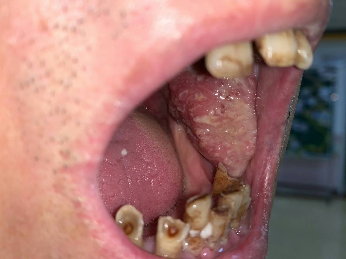 口腔肿瘤照片图片
