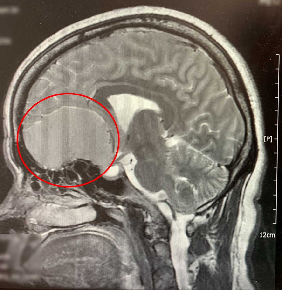 停经妇女注意 嗅觉视觉改变慎防嗅沟脑膜瘤