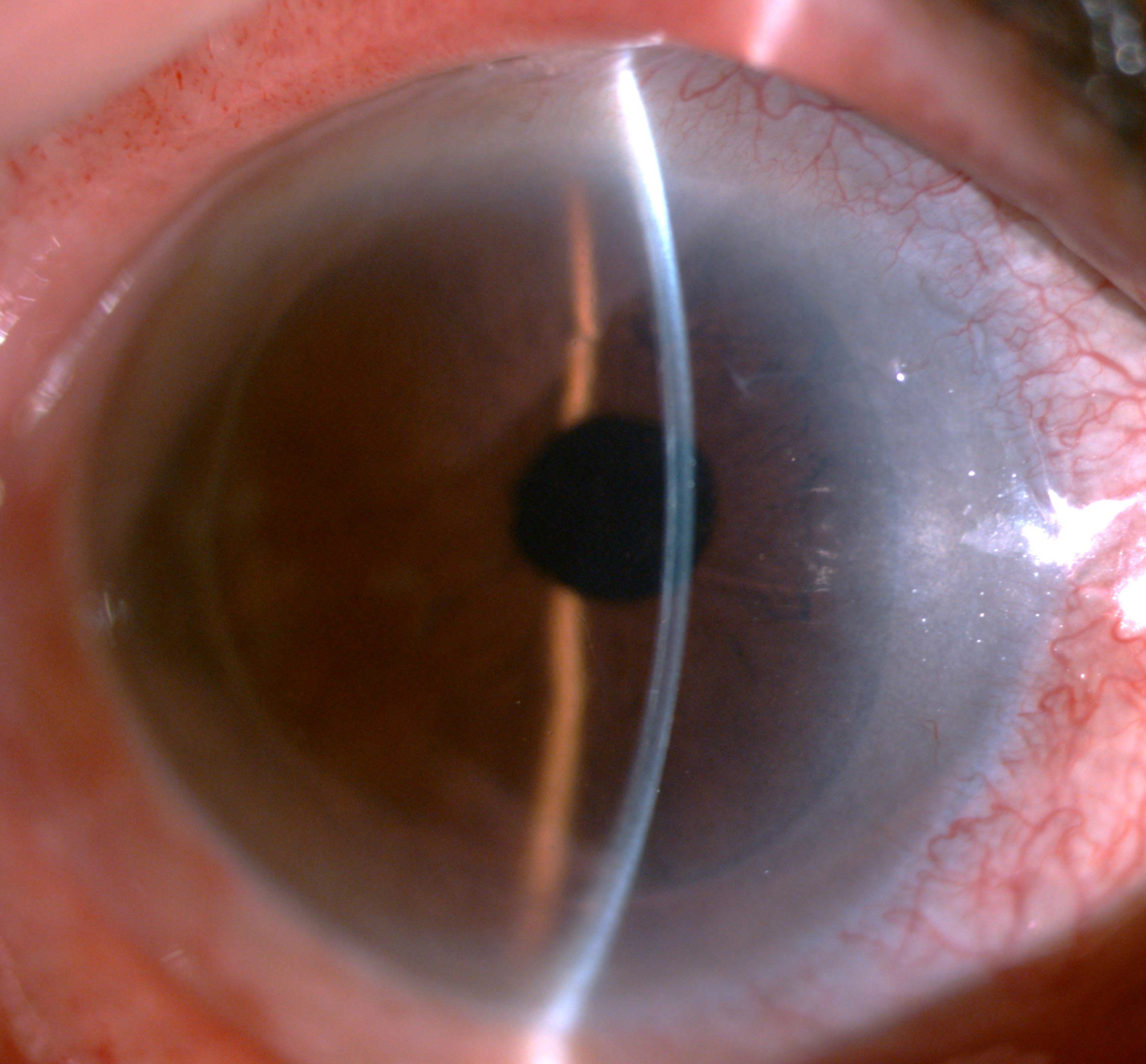 换心瓣膜伤口只有7公分 内视镜微创成主流